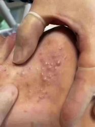 -靓芙泉祛痘.科技美肤连锁