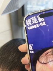 -碧莲盛·不剃发植发