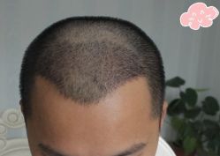 -大麦微针植发丨全国连锁