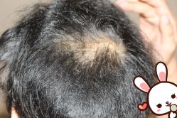 -大麦微针植发丨全国连锁