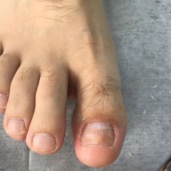 点击看大图 -德哥灰指甲脚气甲沟炎跖疣护理