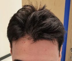 -大麦微针植发全国连锁