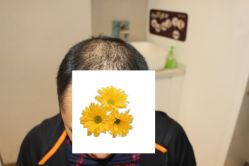-大麦微针植发丨全国连锁