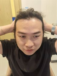 -大麦微针植发全国连锁