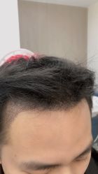 体验后-大麦微针植发全国连锁