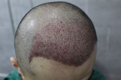 点击看大图 -大麦微针植发丨全国连锁