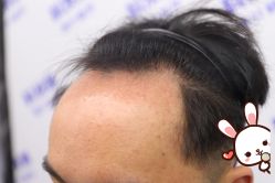 -大麦微针植发丨全国连锁