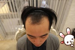 -大麦微针植发丨全国连锁