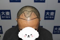 点击看大图 -大麦微针植发丨全国连锁