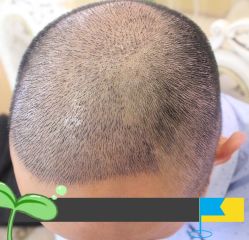 -大麦微针植发丨全国连锁