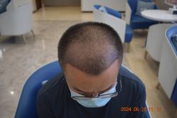 体验后-大麦微针植发全国连锁