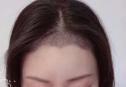 -大麦微针植发丨全国连锁