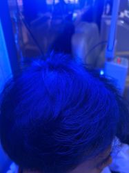 -碧莲盛·不剃发植发