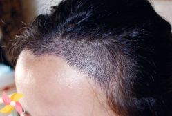 -大麦微针植发丨全国连锁