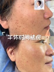 -美丽人生祛斑扁平疣汗管瘤中心