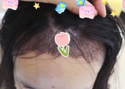 -大麦微针植发全国连锁