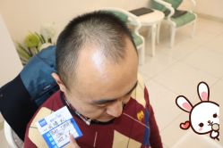 -大麦微针植发丨全国连锁