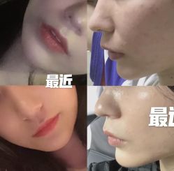 体验后-西安壹加壹医疗美容·西北抗衰旗舰店