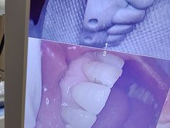 -上海仁爱医院口腔科 · 种植