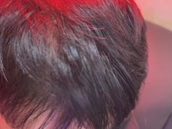 -碧莲盛·不剃发植发