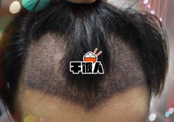 -大麦微针植发全国连锁