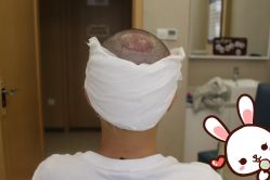 -大麦微针植发丨全国连锁