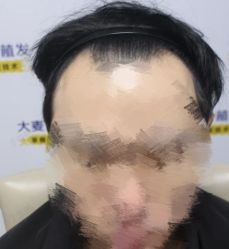 -大麦微针植发丨全国连锁