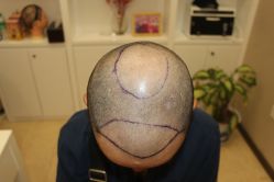 -大麦微针植发丨全国连锁