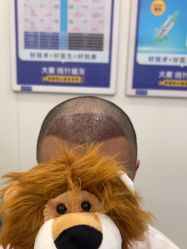 点击看大图 -大麦微针植发全国连锁