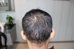 -大麦微针植发丨全国连锁