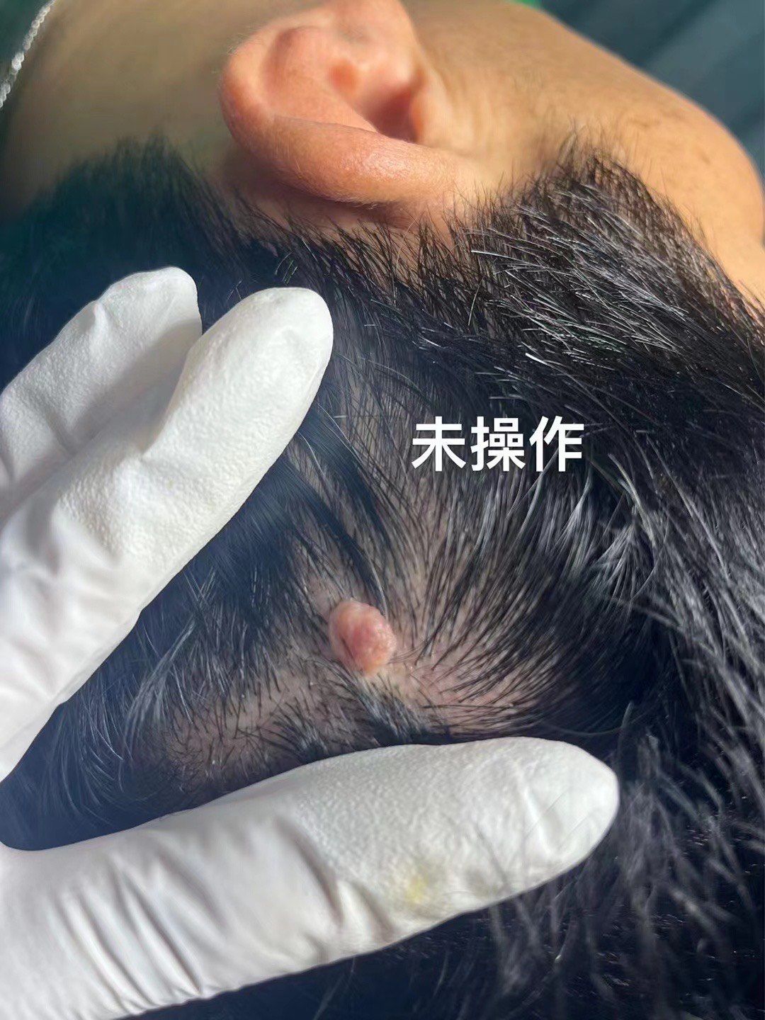 林院长元痕祛除头皮上大血管瘤完美修复过程!