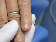 -Andrew指甲专科灰指甲·甲沟炎矫正·3D步态矫形鞋垫定制(上海法华镇路旗舰店)