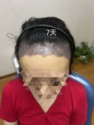 体验后-大麦微针植发全国连锁