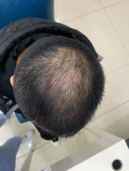 点击看大图 体验后-大麦微针植发丨全国连锁
