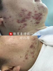 -靓芙泉专研痘痘肌