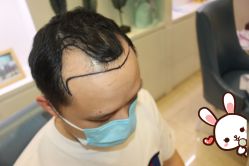 -大麦微针植发丨全国连锁