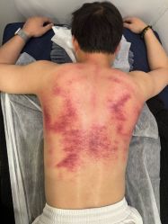 -寇氏拔罐减肥