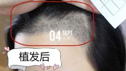 -大麦微针植发全国连锁