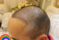 -大麦微针植发丨全国连锁