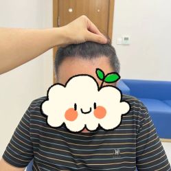 -大麦微针植发全国连锁