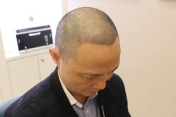 点击看大图 -大麦微针植发丨全国连锁