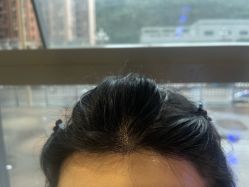 -碧莲盛·不剃发植发