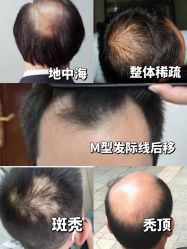 点击看大图 -极客侠男士假发定制补发