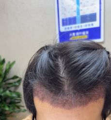 -大麦微针植发全国连锁