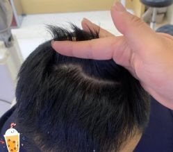 -大麦微针植发丨全国连锁