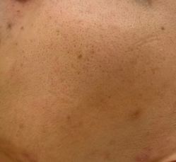 -美肤盾祛痘·问题肌头疗管理中心