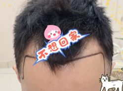 -大麦微针植发全国连锁