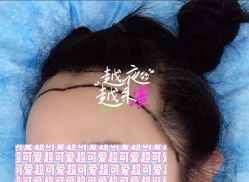 -大麦微针植发全国连锁