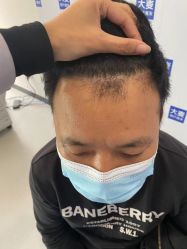 体验后-大麦微针植发全国连锁
