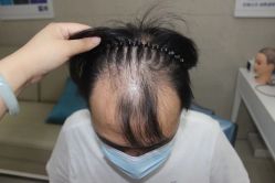 点击看大图 -大麦微针植发全国连锁